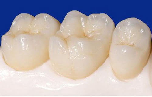 Răng sứ bị mẻ - Tìm ra nguyên nhân để phòng tránh 1 Răng sứ bị mẻ - Tìm ra nguyên nhân để phòng tránh 1