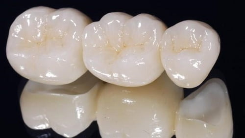 Răng sứ cercon giá bao nhiêu? Các yếu tố nào chi phối? 1