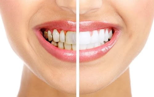 Răng sứ có tẩy trắng được không? Giải pháp khi răng đổi màu 2