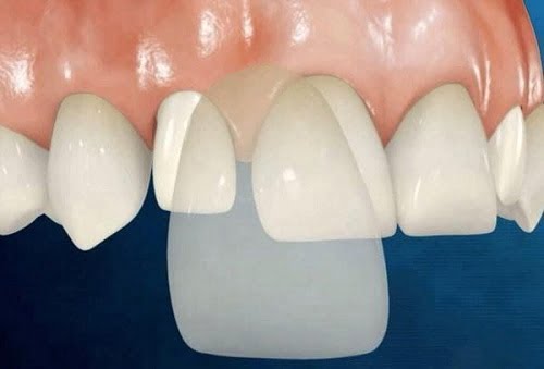 Răng sứ có tẩy trắng được không? Giải pháp khi răng đổi màu 3