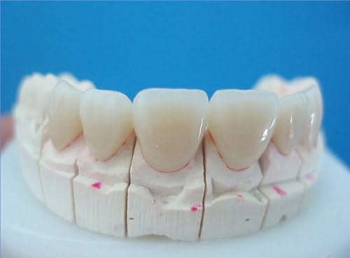Thông tin về răng sứ không kim loại bạn nhất định phải biết 1