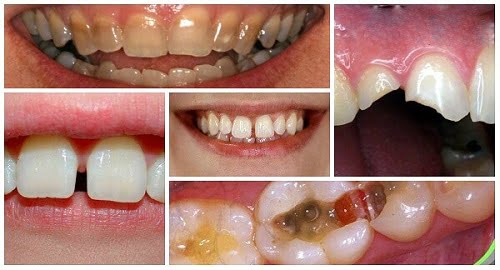 Thông tin về răng sứ không kim loại bạn nhất định phải biết 3