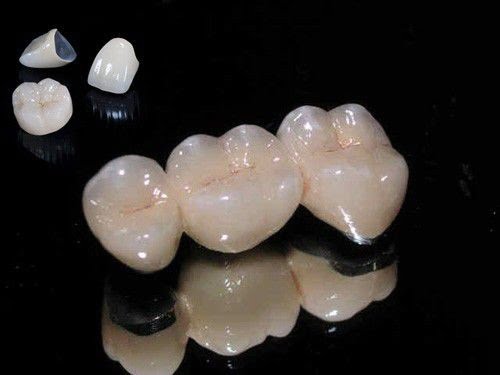 Răng sứ kim loại - Giới thiệu các đặc tính cơ bản nhất 1