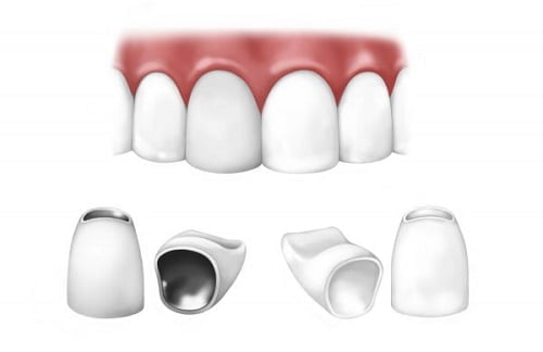 Răng sứ kim loại - Giới thiệu các đặc tính cơ bản nhất 2