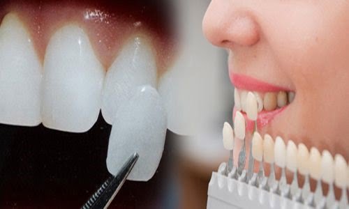 Làm răng sứ veneer có tốt không với răng cửa nhiễm màu? 1