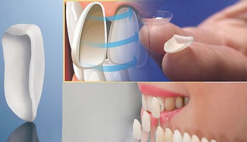 Làm răng sứ veneer có tốt không với răng cửa nhiễm màu? 2