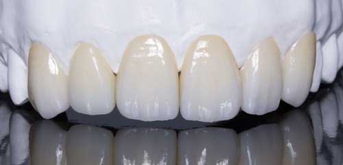 1 hàm răng sứ bao nhiêu tiền là duy trì kết quả lâu nhất? 2