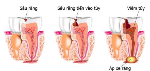Bọc răng sứ có phải lấy tủy không khi răng bị sâu? 2