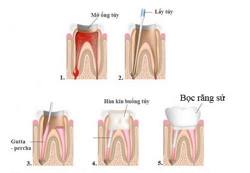 Bọc răng sứ có phải lấy tủy không khi răng bị sâu? 3