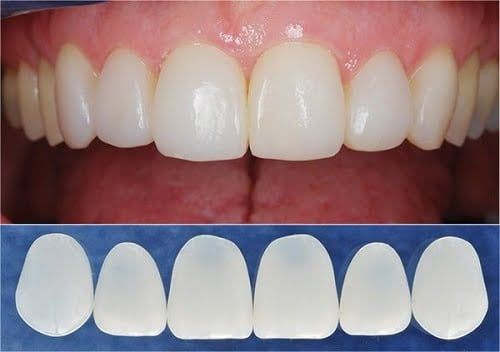 Làm răng sứ cả hàm thích hợp trong trường hợp nào? 1