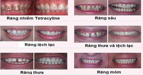 Làm răng sứ cả hàm thích hợp trong trường hợp nào? 2