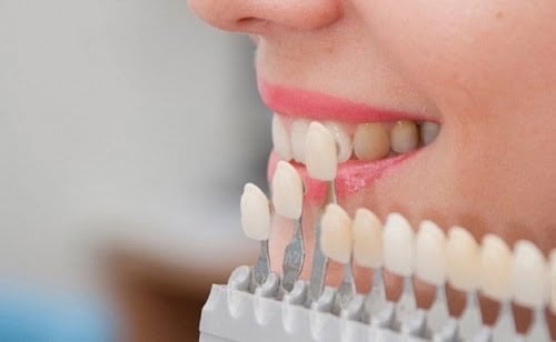 Làm răng sứ cả hàm thích hợp trong trường hợp nào? 3
