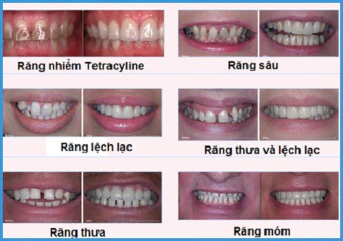 Làm răng sứ có đau không áp dụng với răng bị hô? 2