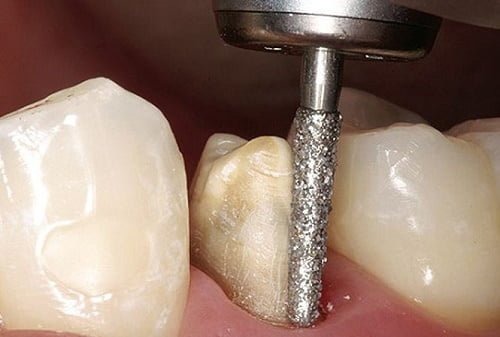 Làm răng sứ có đau không áp dụng với răng bị hô? 3