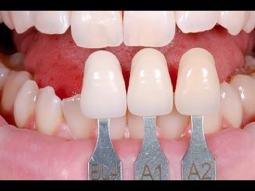 Làm răng sứ có niềng răng được không? Có bền không? 3