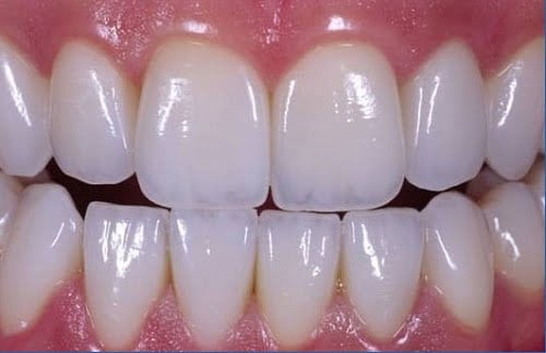 Làm răng sứ không mài răng an toàn nhẹ nhàng hiệu quả 1