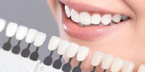 Làm răng sứ không mài răng an toàn nhẹ nhàng hiệu quả 2