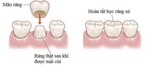 Làm răng sứ phải kiêng gì để đảm bảo độ bền cho răng? 1