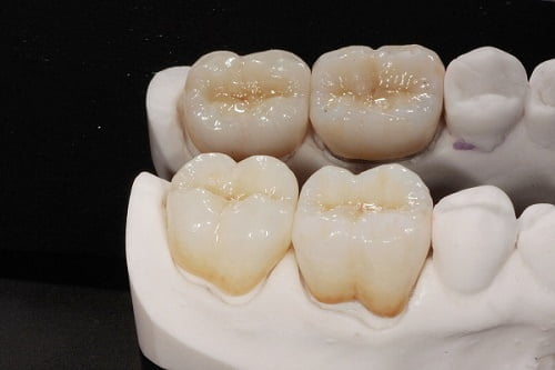Làm răng sứ sau bao lâu thì hết ê buốt và ăn được? 1 Làm răng sứ sau bao lâu thì hết ê buốt và ăn được? 1