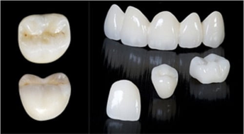 Làm răng sứ thẩm mỹ loại nào tốt? Phân tích từ nha khoa 2