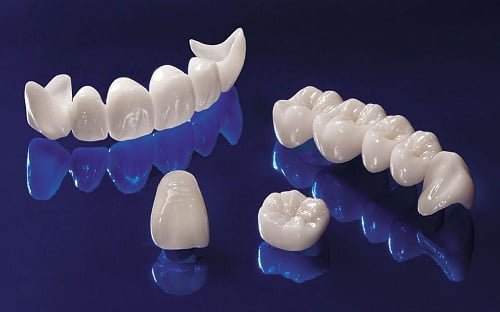 Làm răng sứ thẩm mỹ loại nào tốt? Phân tích từ nha khoa 3