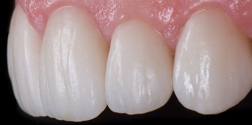 Lắp răng sứ bị sưng lợi - Cập rập truy tìm nguyên nhân 1 Lắp răng sứ bị sưng lợi - Cập rập truy tìm nguyên nhân 1