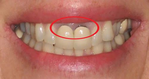 Răng sứ bị đen viền nướu do đâu? Cách khắc phục là gì? 1