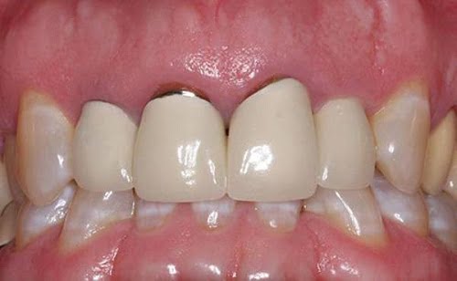 Răng sứ bị hở nên điều chỉnh hay bọc lại? 2