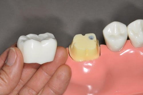 Răng sứ bị hở nên điều chỉnh hay bọc lại? 3