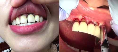 Răng sứ bị hỏng - Nhiều hậu họa tiềm ẩn bạn chưa biết 3 Răng sứ bị hỏng - Nhiều hậu họa tiềm ẩn bạn chưa biết 3