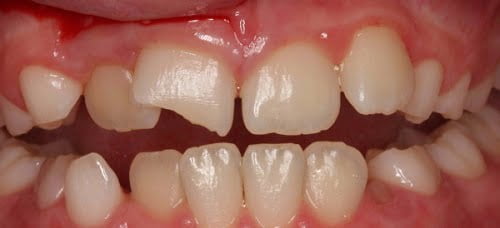 Răng sứ bị mòn - Nhận định từ chuyên gia nha khoa 2 Răng sứ bị mòn - Nhận định từ chuyên gia nha khoa 2