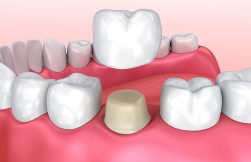 Răng sứ bị nứt - Tìm kiếm nguyên nhân và cách khắc phục 1 Răng sứ bị nứt - Tìm kiếm nguyên nhân và cách khắc phục 1