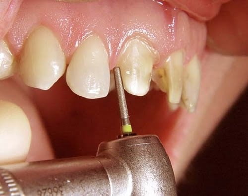 Răng sứ bị sâu khi nào? Có nên tháo răng sứ khi bị sâu răng? 2