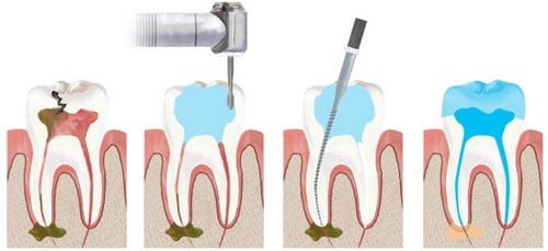 Răng sứ bị sâu khi nào? Có nên tháo răng sứ khi bị sâu răng? 3