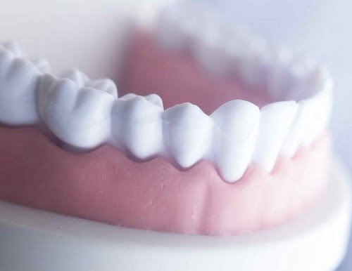 Răng sứ bị thưa thì có khắc phục được không? 3