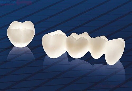 Răng sứ ceramill thuộc nhóm nào? Có những ưu điểm gì? 3