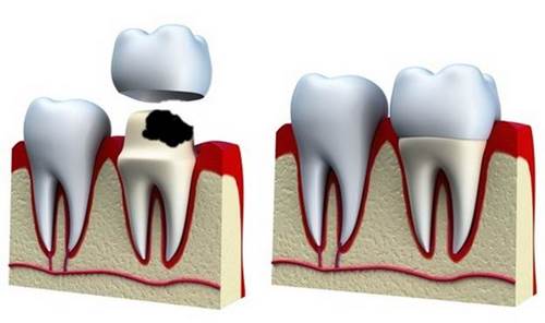 Răng sứ có bị sâu không? Làm gì để bảo vệ răng sứ? 3