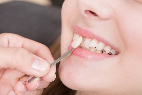Răng sứ có mài được không khi bị dài hơn răng thật? 1