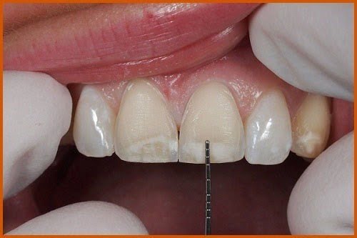 Răng sứ có mài được không khi bị dài hơn răng thật? 2