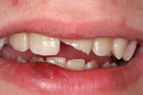 Răng sứ có trám được không khi bị mẻ góc? 1