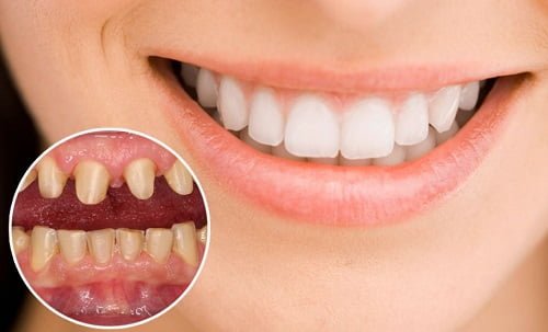 Răng sứ gây hôi miệng - Cách khắc phục hiệu quả cho bạn 1
