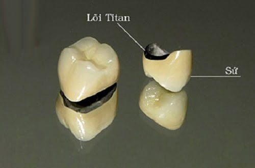 Răng sứ titan có bị đen không? Thông tin tư vấn 1