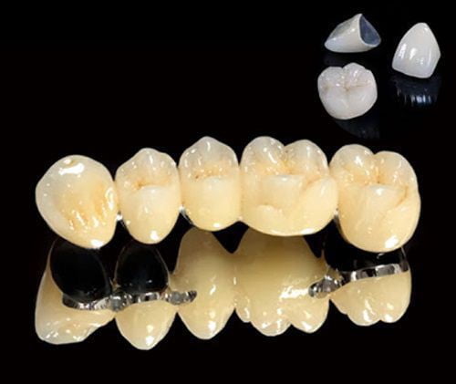 Răng sứ titan có mấy loại? Sử dụng cho trường hợp nào? 2