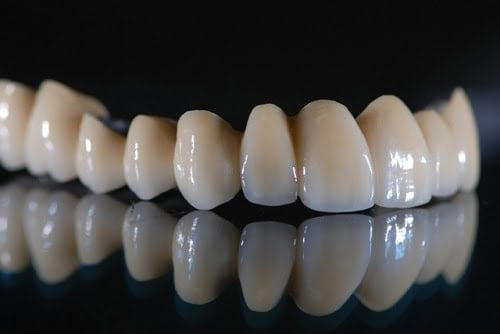 Răng sứ titan sử dụng được bao lâu thì thay mới? 1