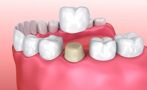 Răng sứ titan sử dụng được bao lâu thì thay mới? 2