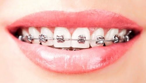 Chi phí niềng răng mắc cài kim loại cập nhật 2019 1