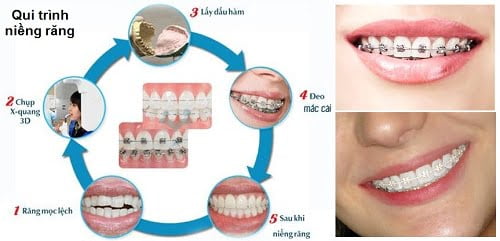 Có nên niềng răng không? Quy trình thực hiện an toàn 3 Có nên niềng răng không? Quy trình thực hiện an toàn 3