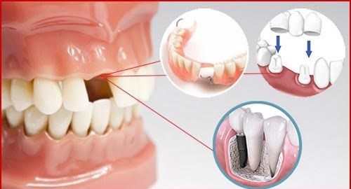 Kỹ thuật trồng răng implant chuẩn quốc tế tại nha khoa  1