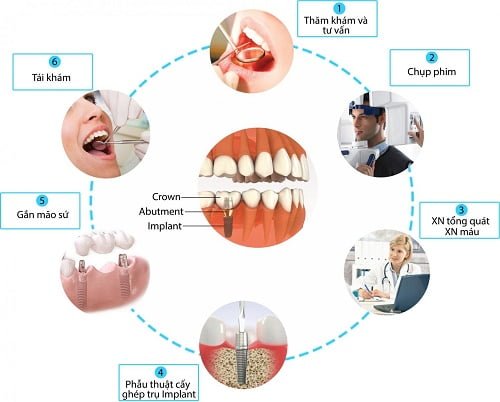 Kỹ thuật trồng răng implant chuẩn quốc tế tại nha khoa  3