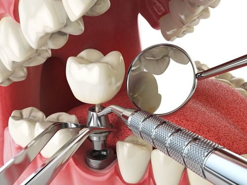 Kỹ thuật trồng răng implant chuẩn quốc tế tại nha khoa  4